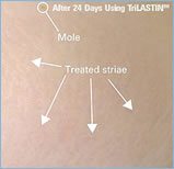 TRILASTIN AFTER