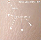 TRILASTIN BEFORE